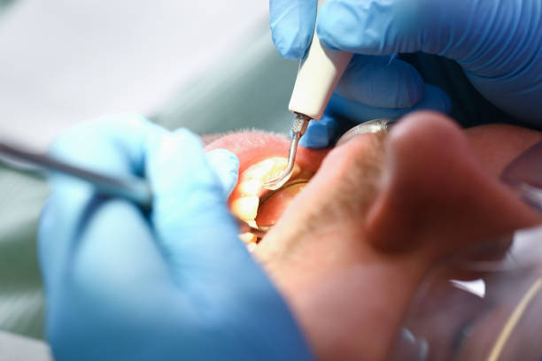 Best Emergency Tooth Extraction in Crystal Springs, MS