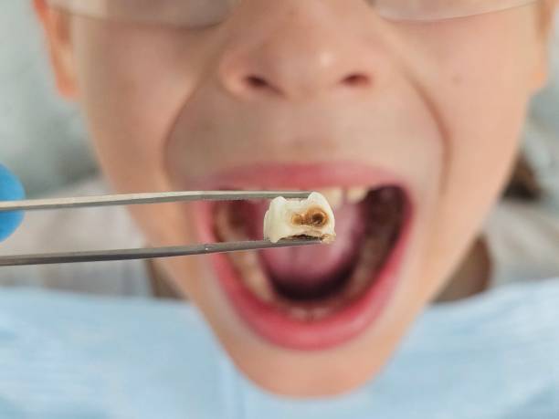 Best Walk-In Emergency Dentist in Crystal Springs, MS